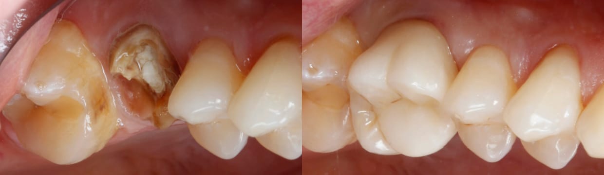 Saving a tooth with Root Canal treatment & Crown Review - Wimpole ...