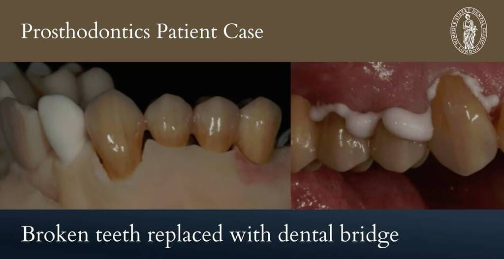 Bridges + Crowns Case 1