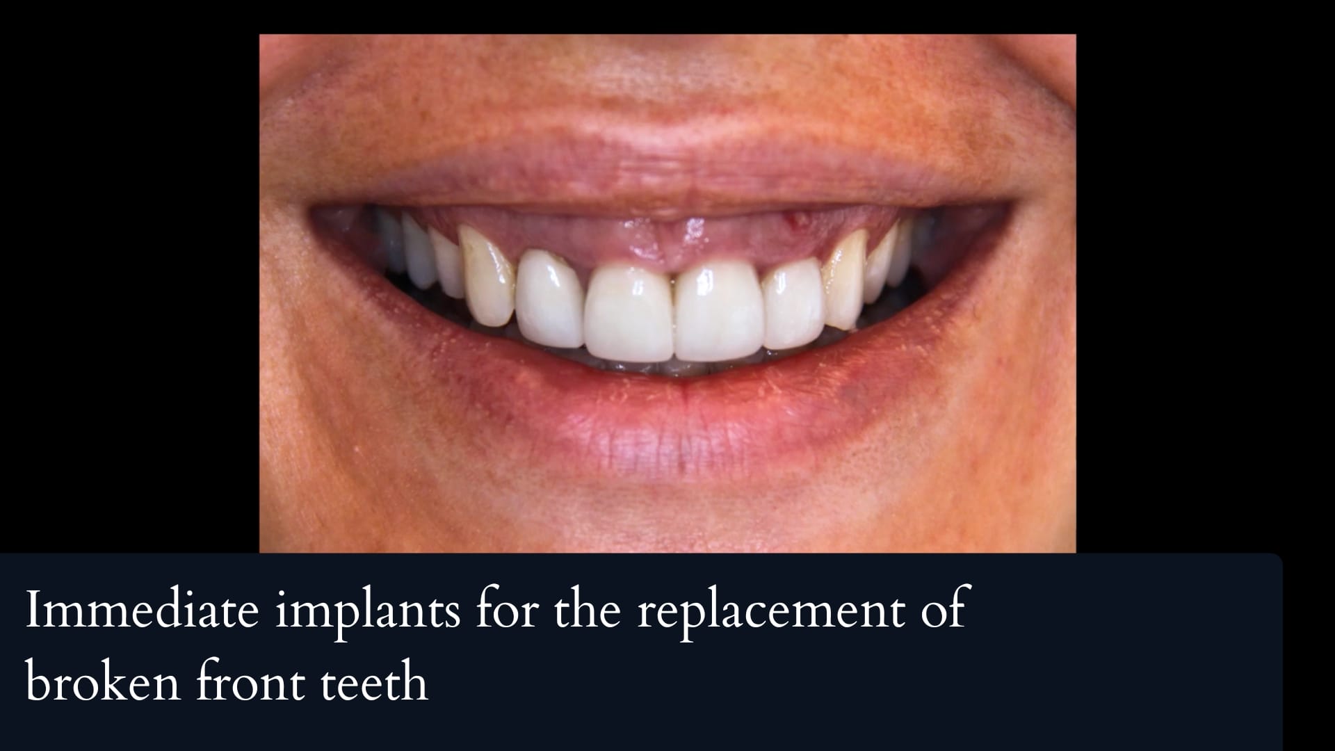 Immediate implants for the replacement of broken front teeth