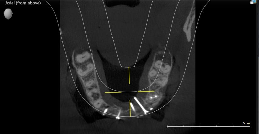 1.4 Thin bone AFTER AUGMENTATION 2