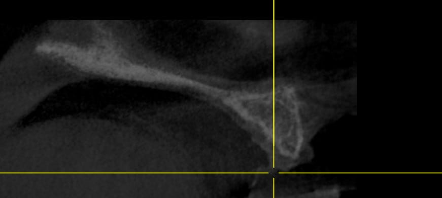 2.2 Medium sized bone 2