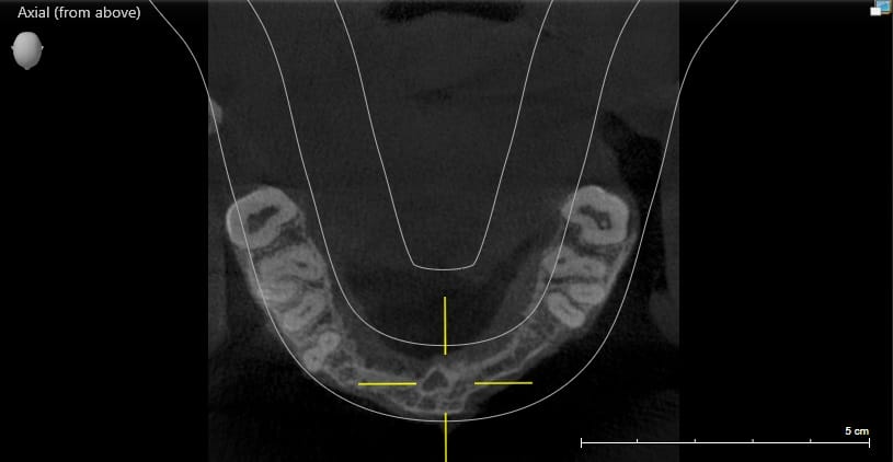 2.3 Medium sized bone 4