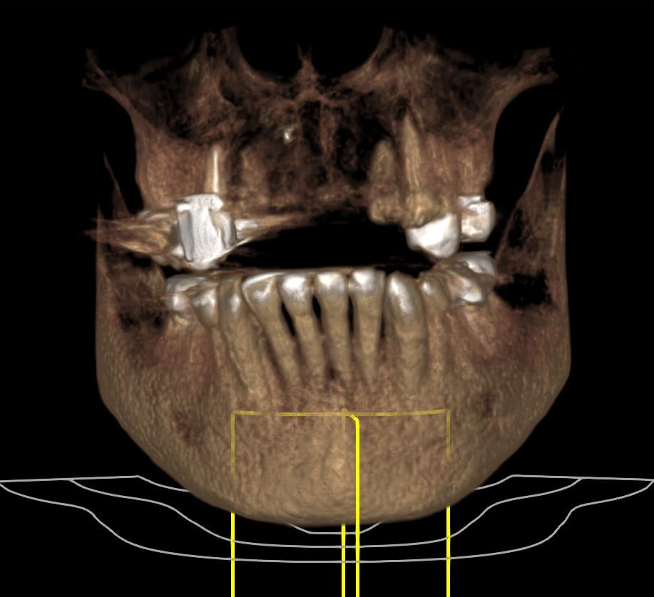 3.1 Large sized bone 4