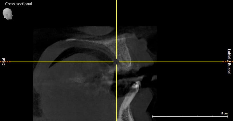 3.2 Large sized bone 2