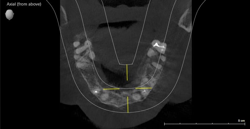 3.3 Large sized bone 3