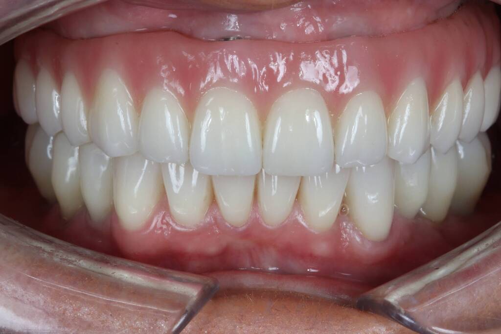 11-final-intra-oral