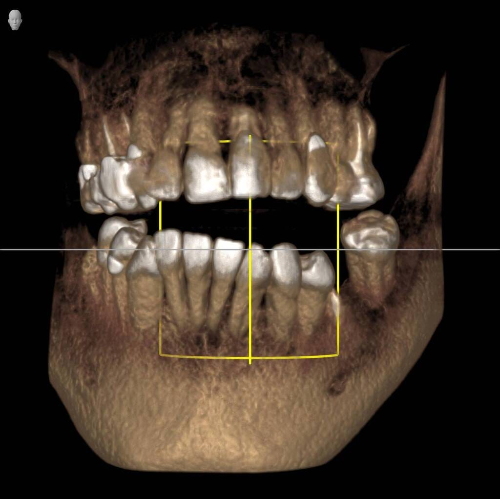 CBCT