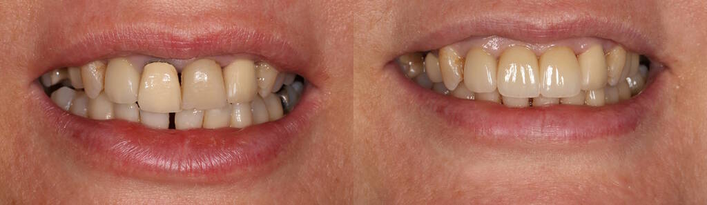 beforeafter