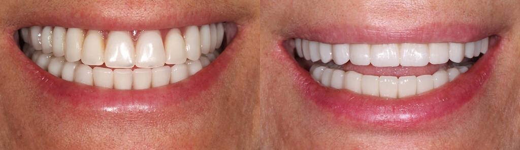 beforeafter127