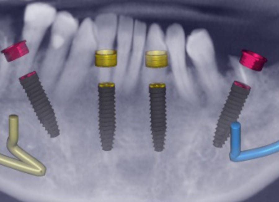 10 Implant planning lower jaw