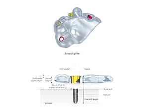 11 Guide upper jaw