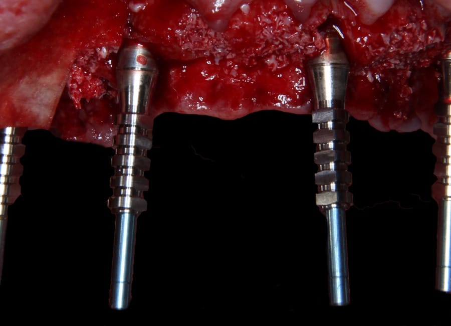 13 Implants placed and bone augmentation and membrane