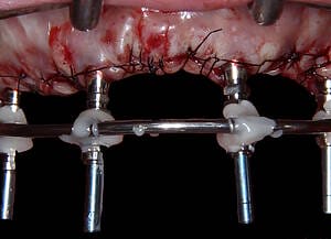 14 Stitched and ready for impression