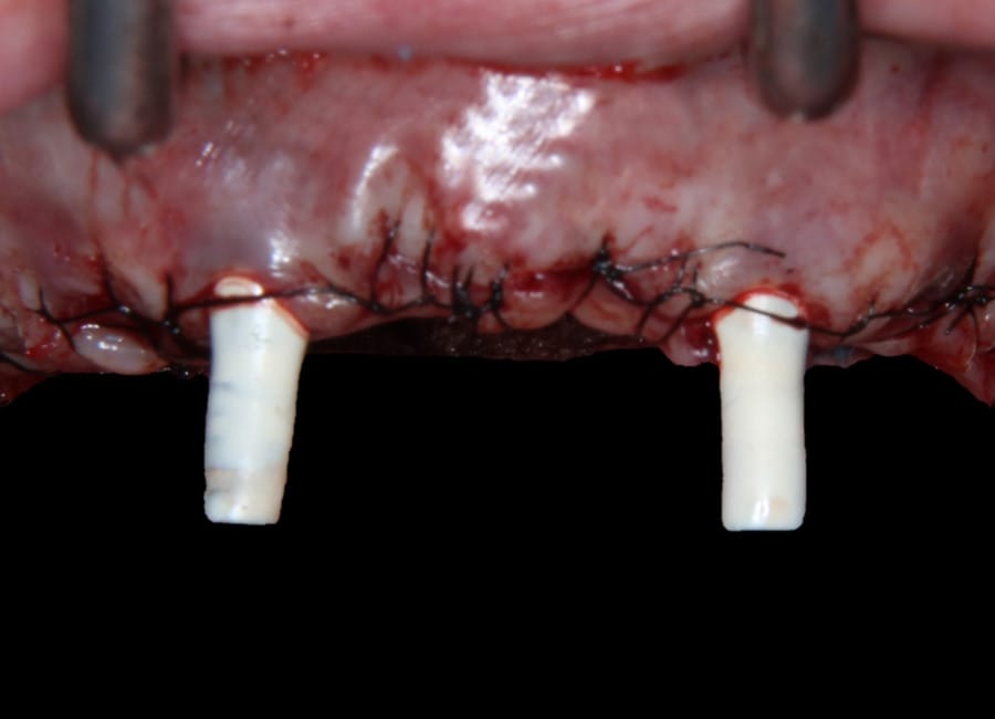 15 Ready for temporary