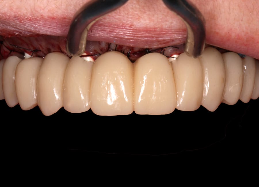 16 Temporary connected to implants