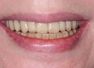 17 Temporary two weeks after operation