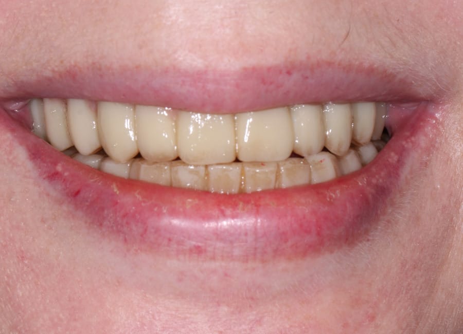 17 Temporary two weeks after operation