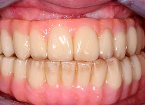 18 Temporary two weeks after operation.JPG