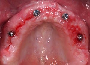 19 Situation three week after operation ready for permanent restoration. upper jaw