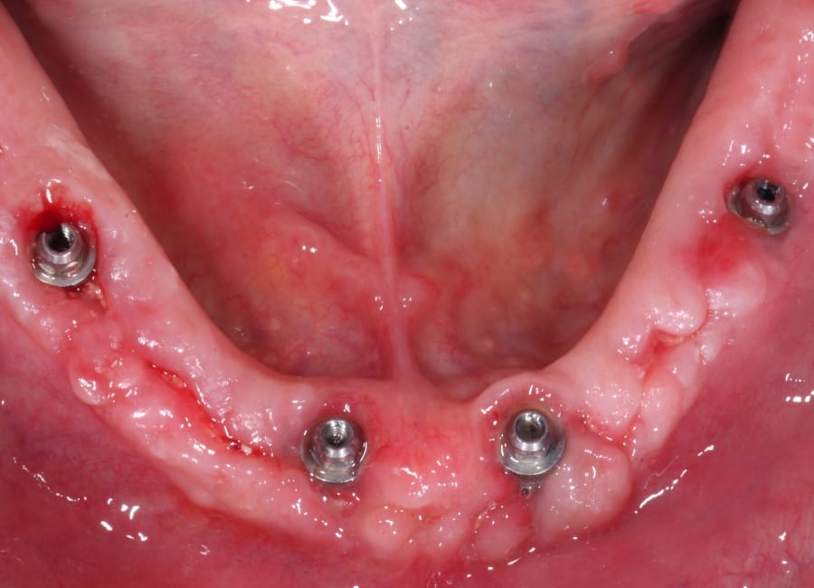 20 Situation three week after operation ready for permanent restoration. upper jawJPG