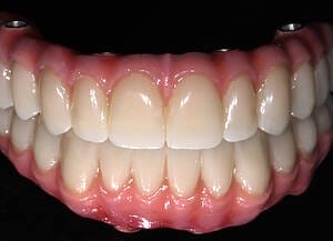 21 Lab work Steel framework and PMMA Teeth