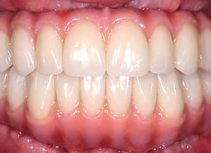 23 After retracted lips