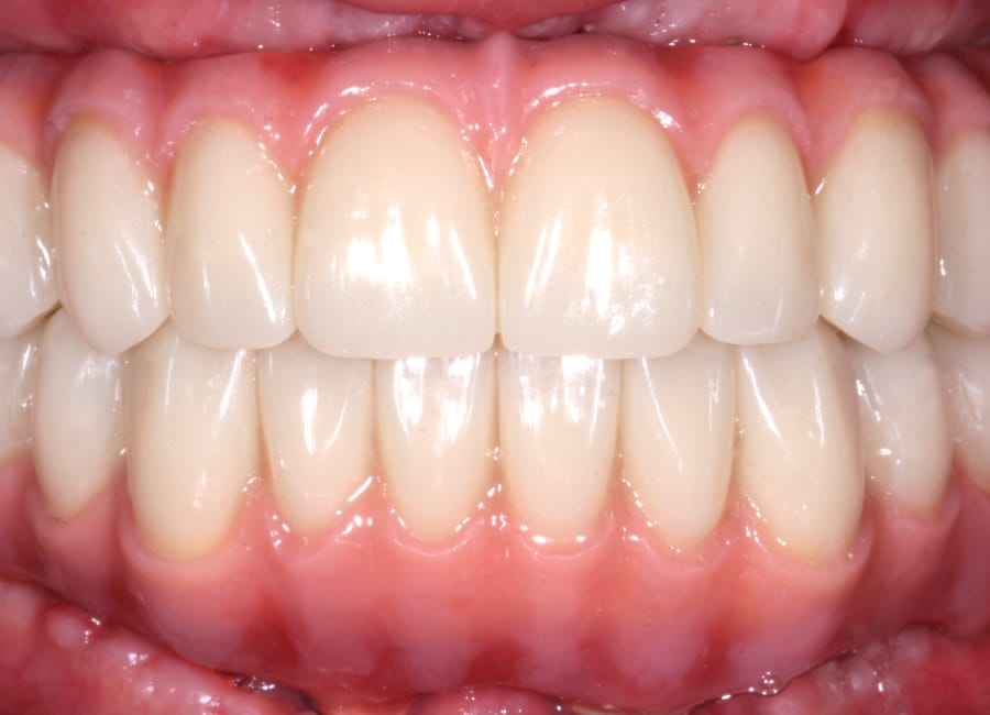 23 After retracted lips