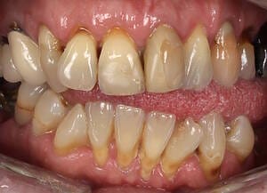 3 Before retracted lips