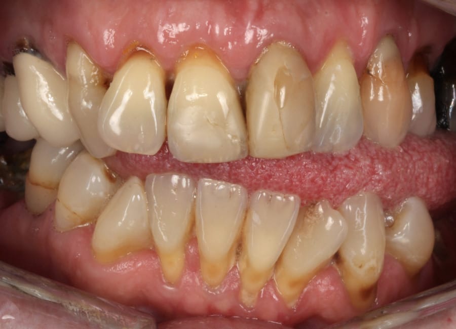 3 Before retracted lips