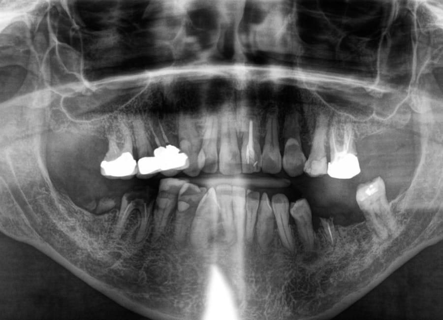 4 Panoramic X-ray before OPG