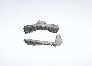 7 All teeth digitally removed