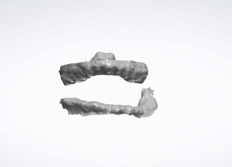 7 All teeth digitally removed