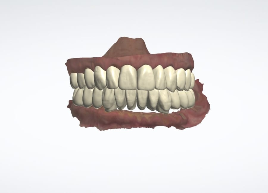 8 New Set up of teeth