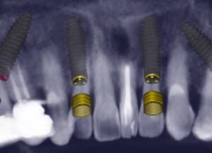 9 Planning of the upper jaw