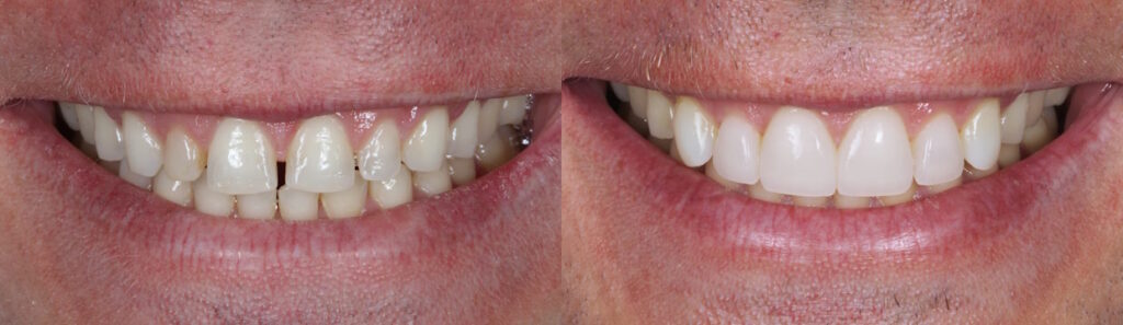 BEFOREAFTER