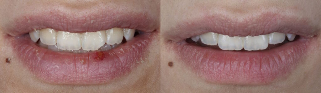 Beforeafter