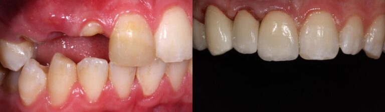 Before and after: Immediate implants