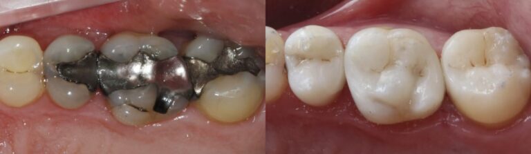 Before and after: Composite Filling