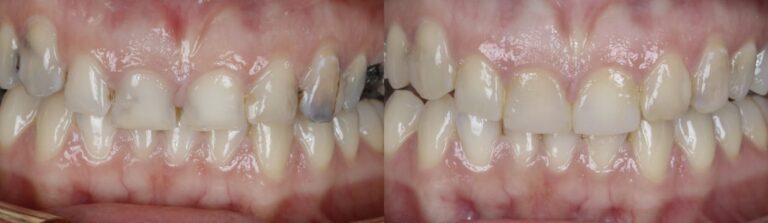 Before and after: Composite Filling