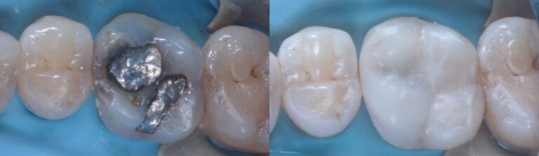 Before and after: Composite Filling