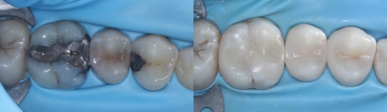 Before and after: Composite Filling