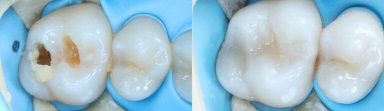 Before and after: Dental Onlay
