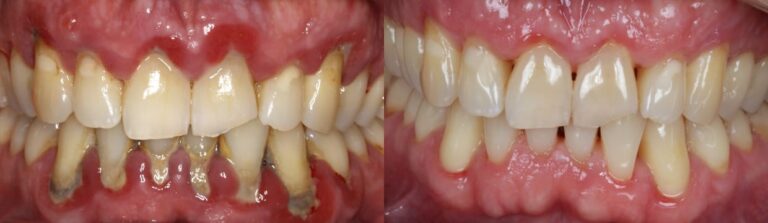 Before and after: Dental Hygiene