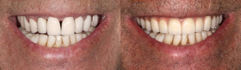 Before and after: Upper jaw all-on-4