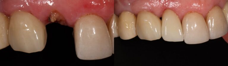 Before and after: Immediate implant