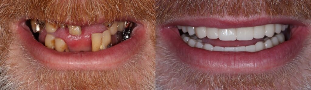 Before and after: Upper and lower jaw All-on-4