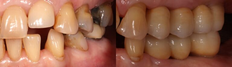 Before and after: Immediate Implants