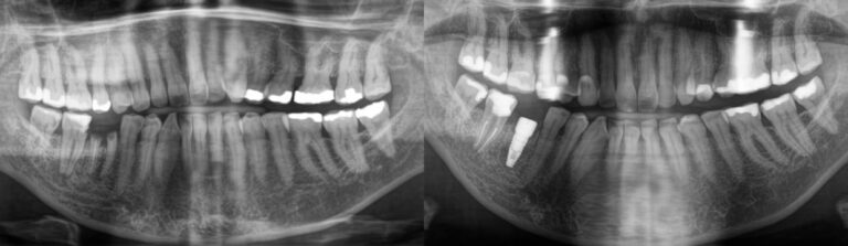 Before and after: Immediate implant