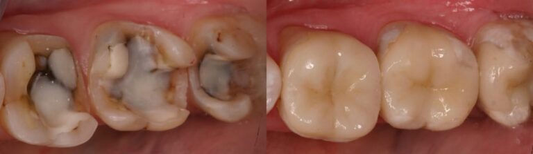 Before and after: Organic Inlays