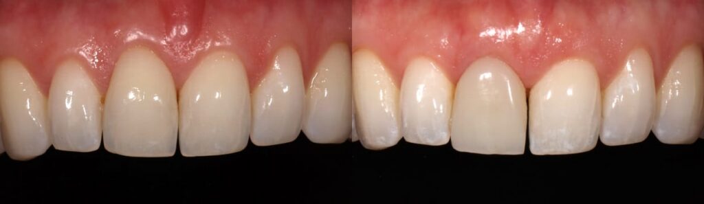 Before and after: A step-by-step approach to immediate implants